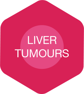 Web-button-liver-tumours
