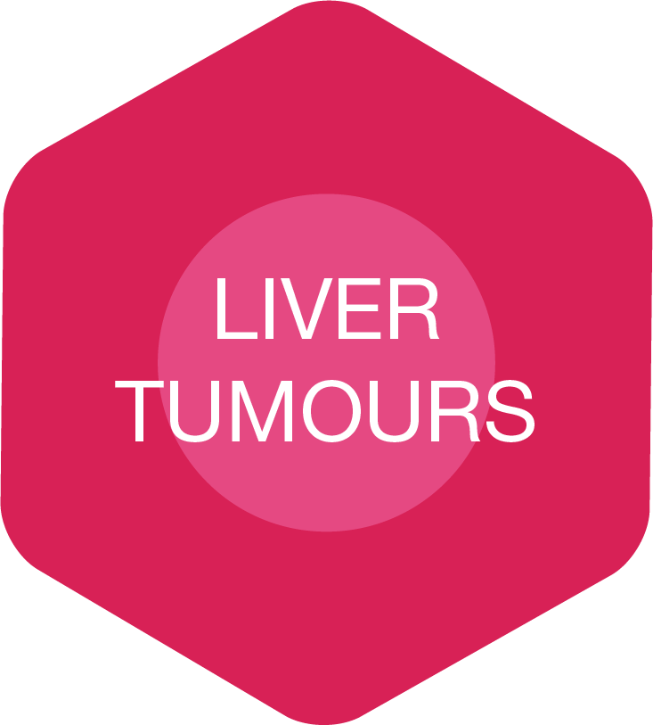 Web-button-liver-tumours